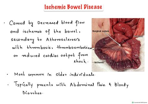 SOLUTION: Ischemic bowel disease - Symptoms, diagnosis and treatment Notes - Studypool