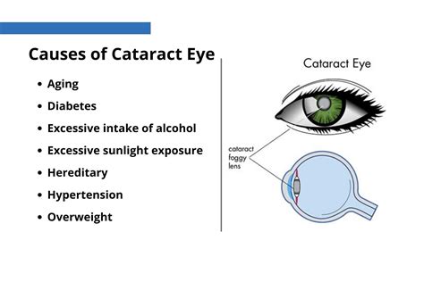 Cataract Is Caused By