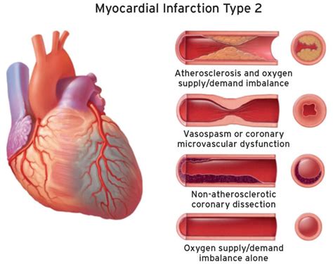 Myocardial infarction definition, causes, signs, symptoms, diagnosis ...