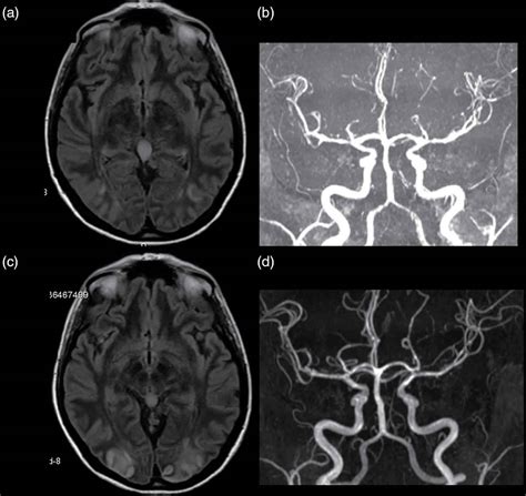 Cerebral vasculitis causes, symptoms, diagnosis, treatment & prognosis