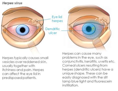 Corneal Abrasion & Ulcer