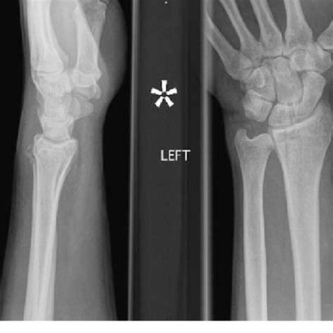 Ulnar Styloid Fracture Splint