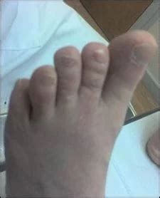 Crossover Toe | Advanced Podiatry - Advanced Podiatry of Manhasset, Huntington, Coram, Woodbury ...