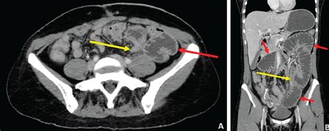 Ct Scan Whole Abdomen With Contrast Price - Captions Profile