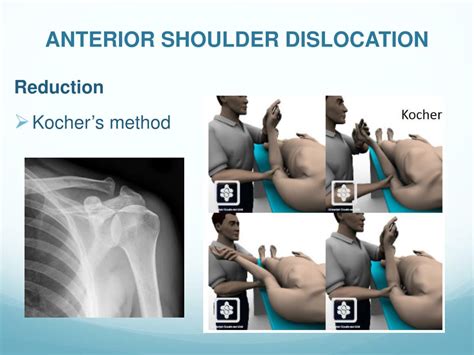 Anterior Shoulder Dislocation Reduction