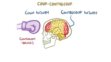 Concussion and traumatic brain injury: Video | Osmosis