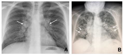 JCM | Free Full-Text | CT Findings in Pulmonary and Abdominal Sarcoidosis. Implications for ...