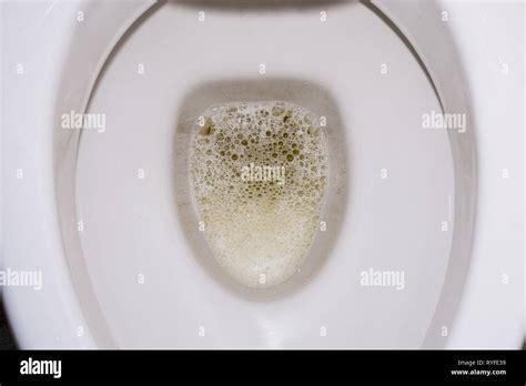 Frothy, foamy, bubbly urine in the toilet bowl. Kidney disease. Protein ...