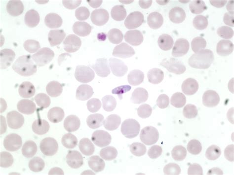 Plasmodium falciparum gametocytes x100mag (2)UK NEQAS | Flickr