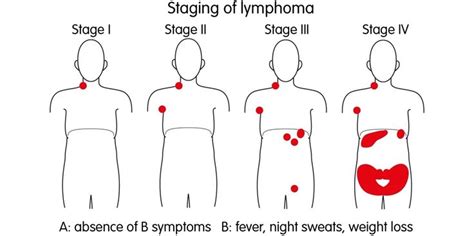 256 best Lymphoma images on Pinterest | Burkitt's lymphoma, Hodgkin's lymphoma and Death