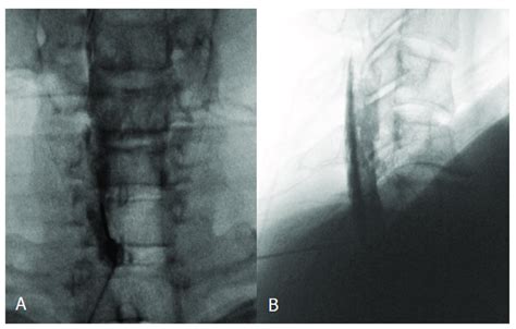 Confirmatory contrast medium spread of cervical interlaminar epidural... | Download Scientific ...