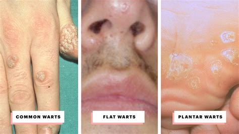 Types of Warts and How to Treat Them - A Visual Guide | Allure