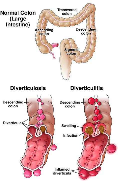 Diverticulitis - AGA GI Patient Center