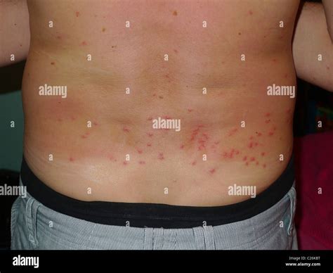 Sandfly bites on a males back. Common in Belize, Thailand and Australia Stock Photo - Alamy