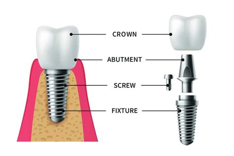 Turkish Teeth Implants: Procedure and Cost - Dentatur