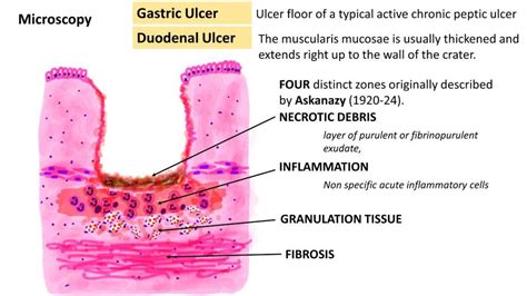 Gastric Ulcer Histology