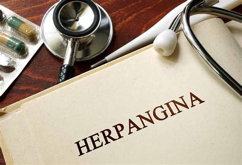 Herpangina in Kids: Reasons, Signs, Treatment & Prevention