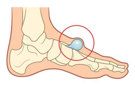 Do you have a Bump on Top of the Foot? [Hard, Painful or Bone Bump]