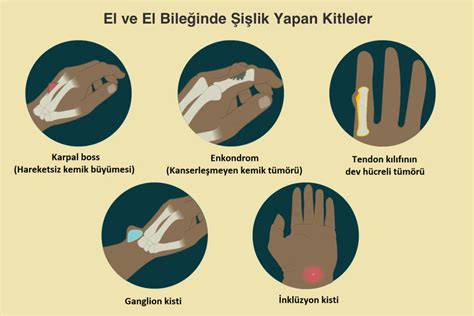 El Bileğinde Şişlik - El Bileğinde Şişlik Yapan Hastalıklar Nelerdir? - Doktor Fizik