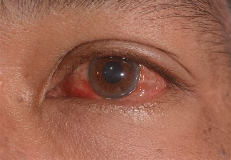 Conjuntivitis Vírica: Tratamiento Eficaz | Área Oftalmológica