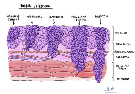 Squamous Cell Carcinoma Histology