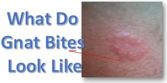 What Do Gnat Bites Look Like? With HD Gnat Pictures | Bites Treatment ...