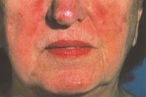 The Best Skin Care Routine for Rosacea | Reader's Digest