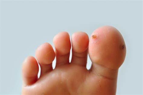 How to Finally Get Rid of Your Foot Warts - Trinity Foot Center