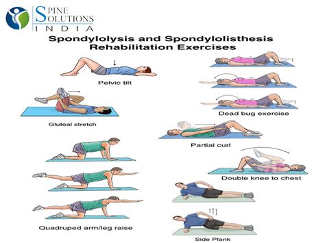 Spine Solutions India by Dr Sudeep Jain: Spondylolisthesis‬: Diagonis and Treatment