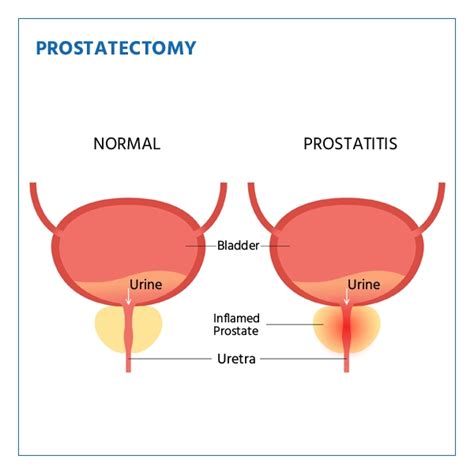 Prostatectomy - Indications, Recovery, Lifestyle Changes.