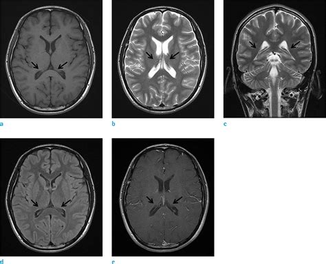 Transfusional Iron Overload and Choroid Plexus Hemosiderosis in a ...