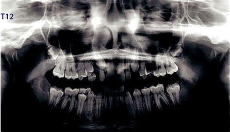 Patient orthopantomogram of 46 at T12. | Download Scientific Diagram