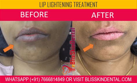 Lip Lightening Treatment in Mumbai