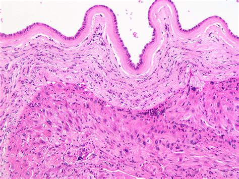 160BChorioamnionitis (low2)