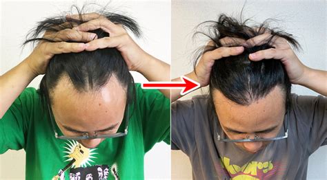 Is it okay to bleach hair that has been surgically transplanted? Seiji reports on his hairline ...