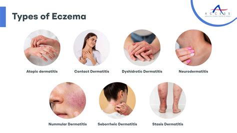 The Tell-all on Eczema | Causes, Types and Treatment