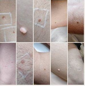 Skin Tag Removal | Wart Treatment | Keratosis | Milia | Edinburgh Scotland