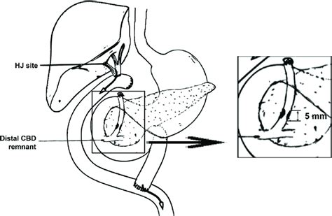 Patient anatomy with CBD stricture. This figure depicts our patient's... | Download Scientific ...