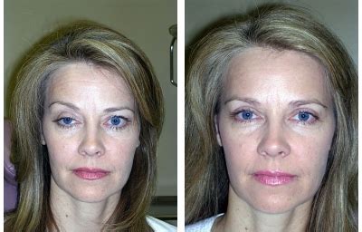 Eyelid Surgery (Blepharoplasty) - East Valley Eye Center, Burbank, CA