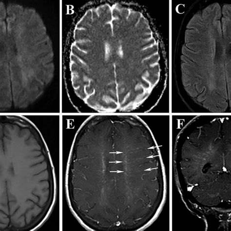 (A) Diffuse periventricular white matter lesions are seen outlining the... | Download Scientific ...