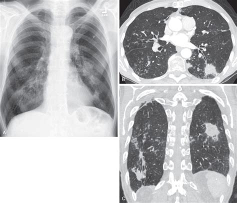 Bronchiolitis | Radiology Key