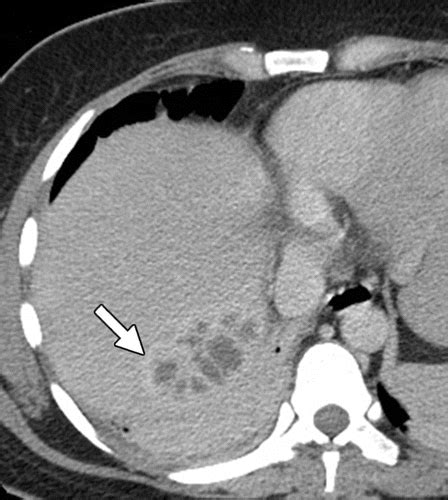 romántico competencia multa candida liver abscess Depresión Cementerio ...