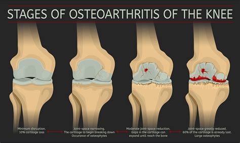 Knee Arthritis - Albuquerque, NM: Modern Pain & Spine