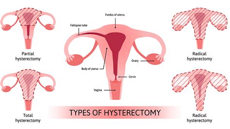 Hysterectomy | NewYork-Presbyterian