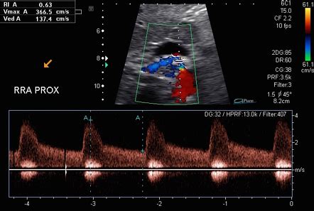 Renal Artery Stenosis Ultrasound