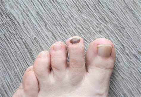 Close Up View of Woman Foot with Black Toenail Caused by Long Walk ...