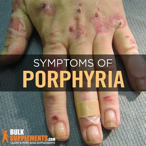 Tablo | Read 'Porphyria: Symptoms, Causes & Treatments' by