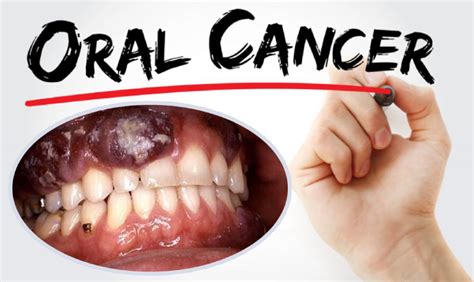 What Are the Types & Treatment for Oral Cancer - Yashoda Hospital