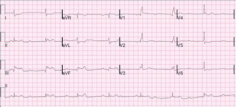 Heart Block On Ecg