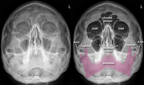 Trauma X-ray - Axial skeleton gallery 1 - Facial bones - Normal anatomy